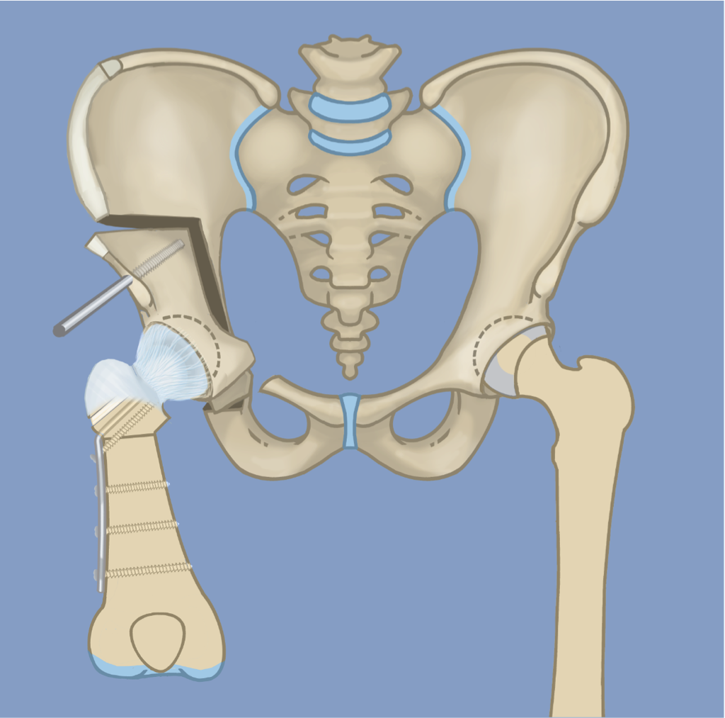  Остеотомия тазобедренного сустава